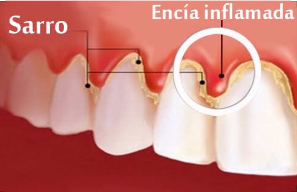 gingivitis 2